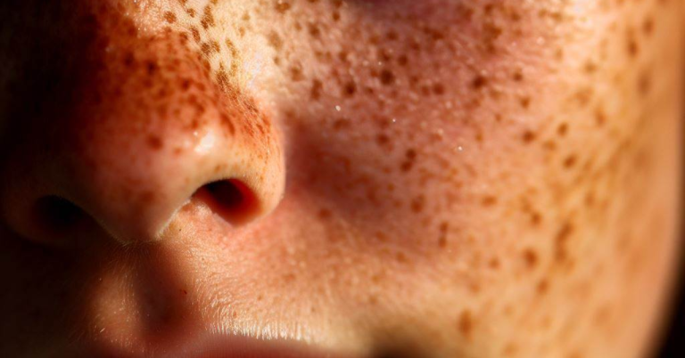Are Freckles Sun Spots